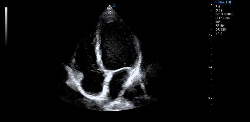 彩超機心臟檢測圖